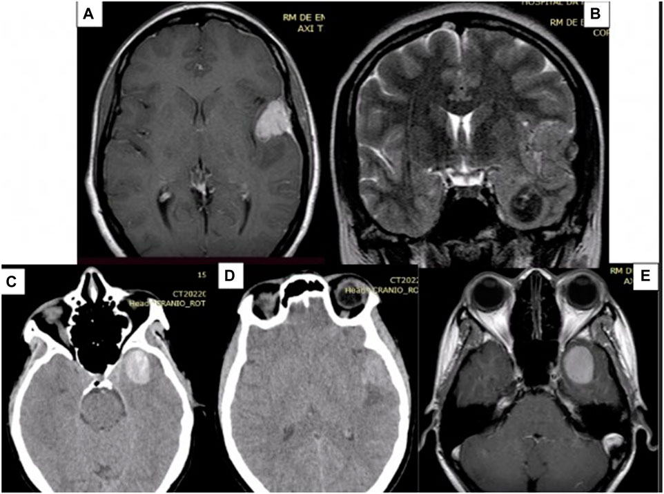 hemorrhagic or melanotic metastatic disease cerebral metastases from malignant melanoma A case of metastatic malignant