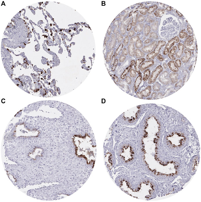 Pathology & Oncology Research | Napsin A Expression in Human Tumors and ...
