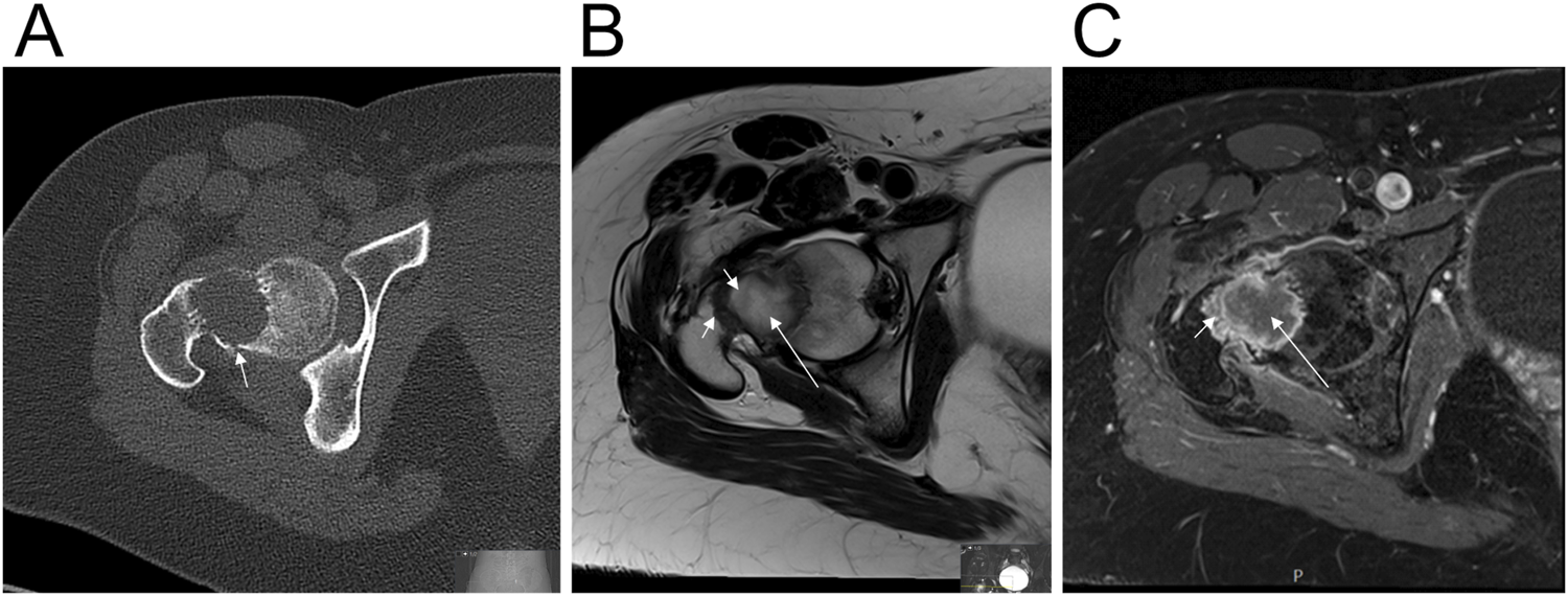 Three-panel medical imaging series showing different views of a pelvic region. Panel A is a CT scan with an arrow indicating a specific area. Panel B is an MRI showing two arrows pointing to structures of interest. Panel C is another MRI with arrows highlighting a similar area as in Panel B.