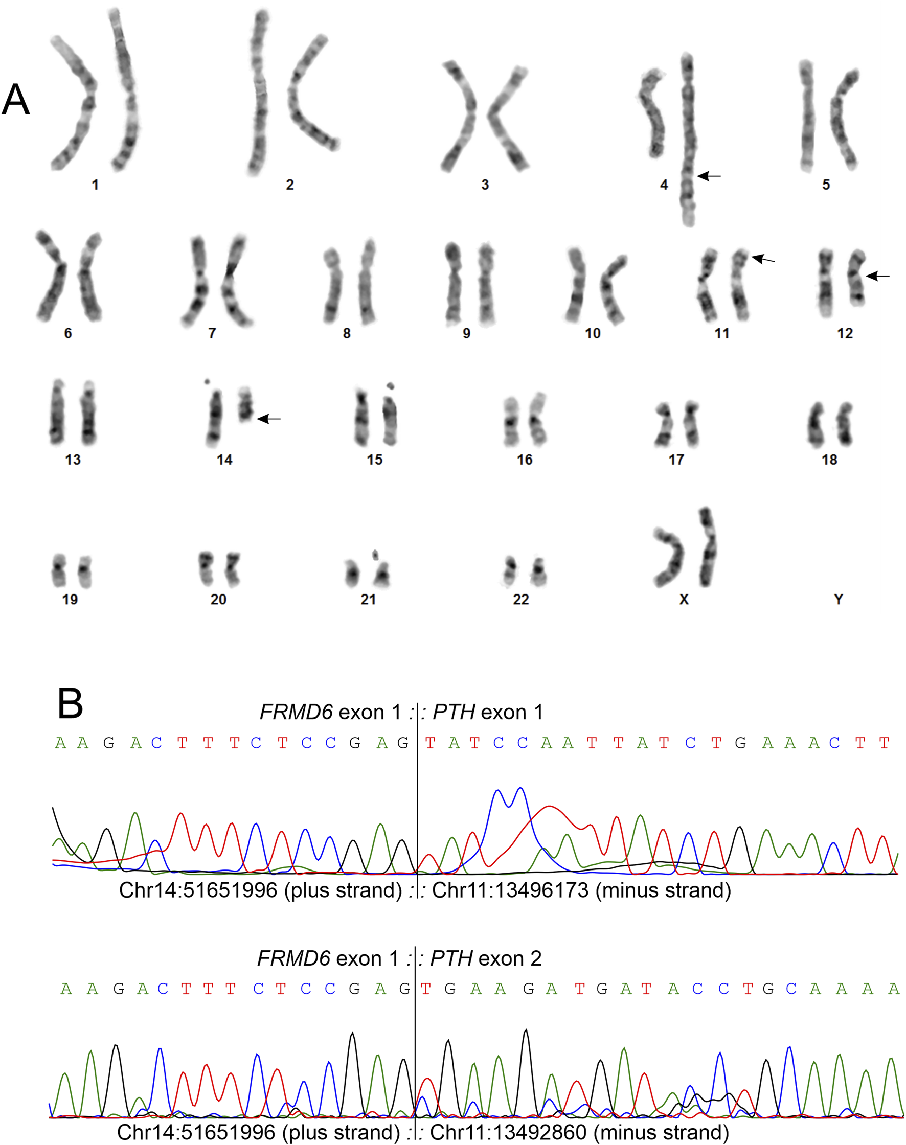 Part A shows a karyotype with 22 pairs of chromosomes and two XX sex chromosomes. Anomalies are indicated on chromosomes 4, 11, and 14. Part B shows DNA sequencing chromatograms comparing sequences for the FRMD6 exon 1 on chromosome 14 and the PTH exons 1 and 2 on chromosome 11, with specific nucleotide sequences and their positions noted.