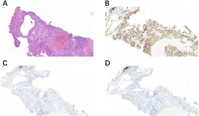 Histological image showing four panels of tissue samples. Panel A displays a hematoxylin and eosin stain highlighting cellular structures. Panel B shows a heavy concentration of brown-stained cells indicating positive immunohistochemical staining. Panels C and D exhibit lighter staining with fewer positively stained cells.