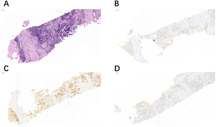 Histological images of tissue samples in four panels labeled A, B, C, and D. Panel A shows a dense purple-stained tissue, indicative of hematoxylin and eosin staining. Panels B, C, and D display varying patterns of lighter staining, suggesting different antibody markers used, with brown highlights in C indicating positive staining regions.