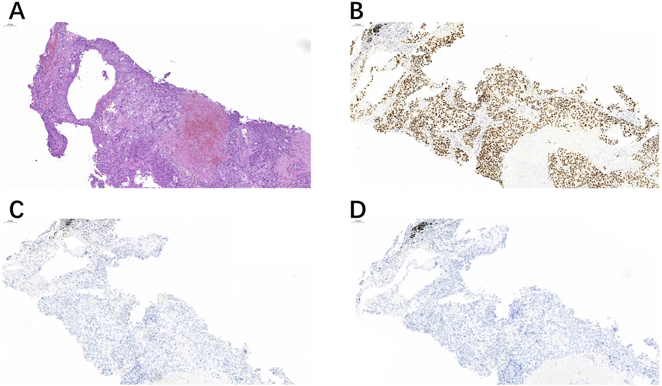 Histological image showing four panels of tissue samples. Panel A displays a hematoxylin and eosin stain highlighting cellular structures. Panel B shows a heavy concentration of brown-stained cells indicating positive immunohistochemical staining. Panels C and D exhibit lighter staining with fewer positively stained cells.