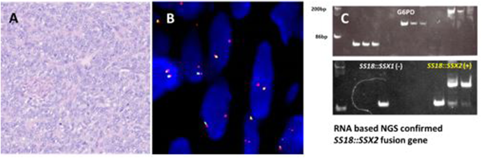 Three panels labeled A, B, and C illustrate different scientific analyses. Panel A shows a histological image with purple coloring. Panel B displays fluorescently labeled cells. Panel C shows gel electrophoresis results with labeled bands. Text indicates RNA-based NGS confirmed an SS18::SSX2 fusion gene.