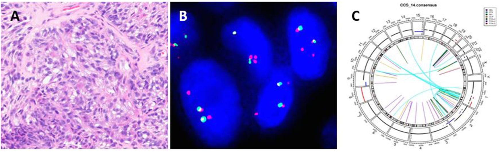 Panel A shows a histological image with dense, irregular clusters of cells stained in pink and purple. Panel B depicts fluorescently labeled cells, with glowing pink and turquoise dots against a blue background. Panel C is a circular genome plot with numbered segments and connecting lines in various colors, indicating genetic relationships or rearrangements.