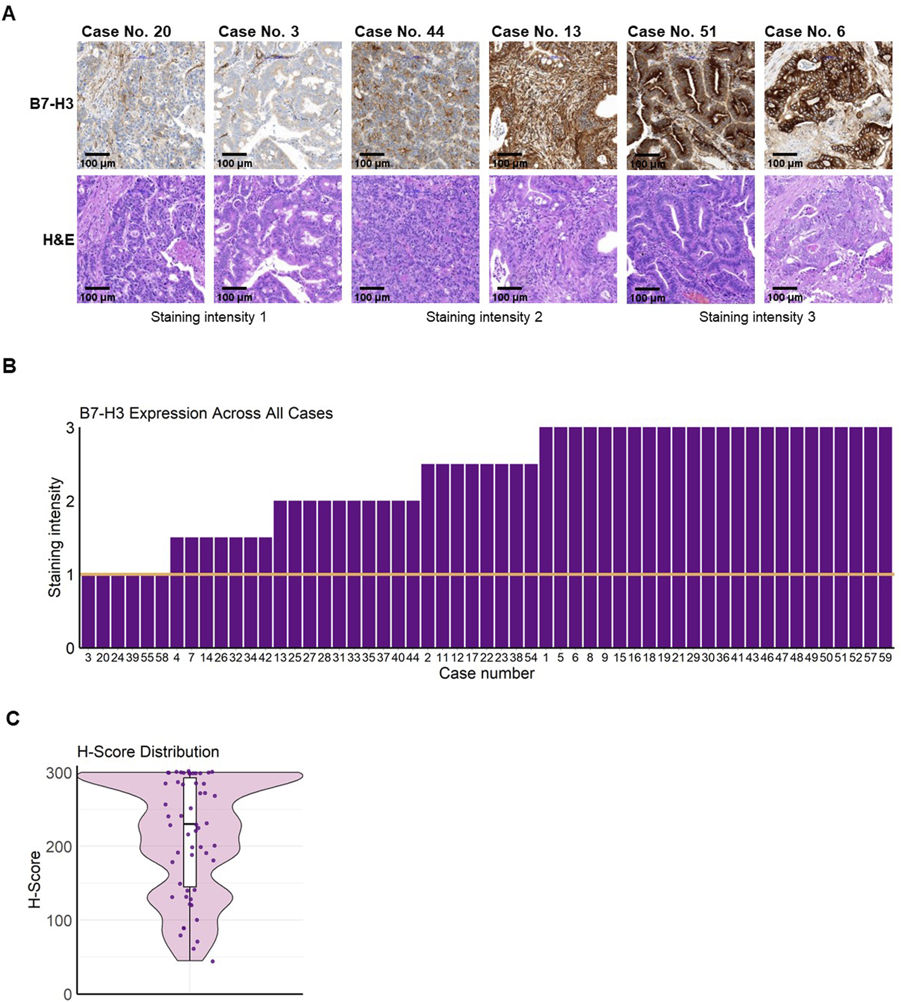 Panel A shows histological images of B7-H3 and H&E stains for cases with varying staining intensities. Panel B is a bar chart displaying B7-H3 expression levels across multiple cases, with staining intensity on the vertical axis and case numbers on the horizontal axis. Panel C is a violin plot representing the distribution of H-scores, with data points and a box plot overlay, indicating variability in scores.