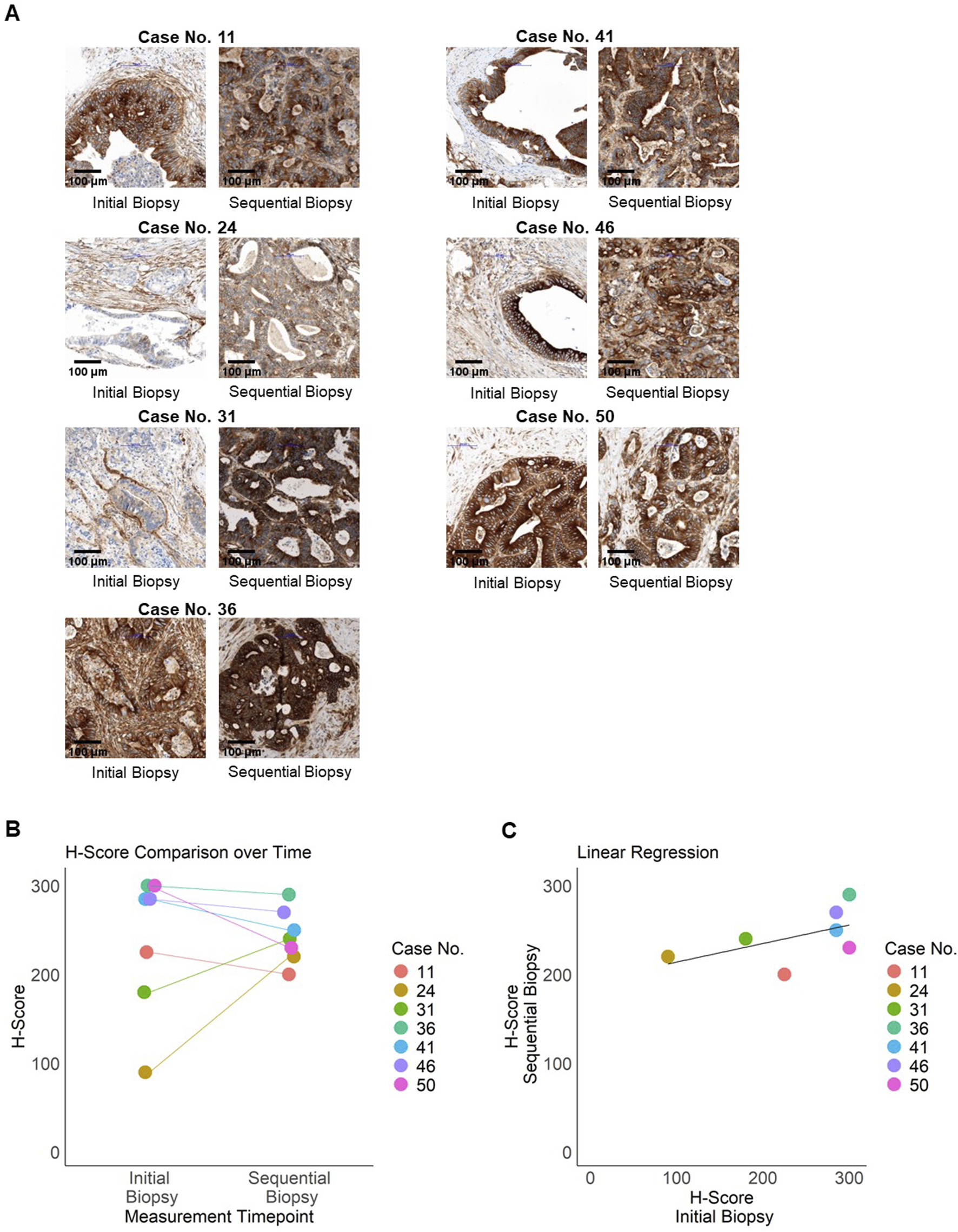 Panel A displays biopsy images from seven cases comparing initial and sequential biopsies with varying staining intensities. Panels B and C show graphs. Panel B illustrates H-Score changes over time for each case with colored points. Panel C presents a linear regression graph showing H-Score correlation between initial and sequential biopsies.
