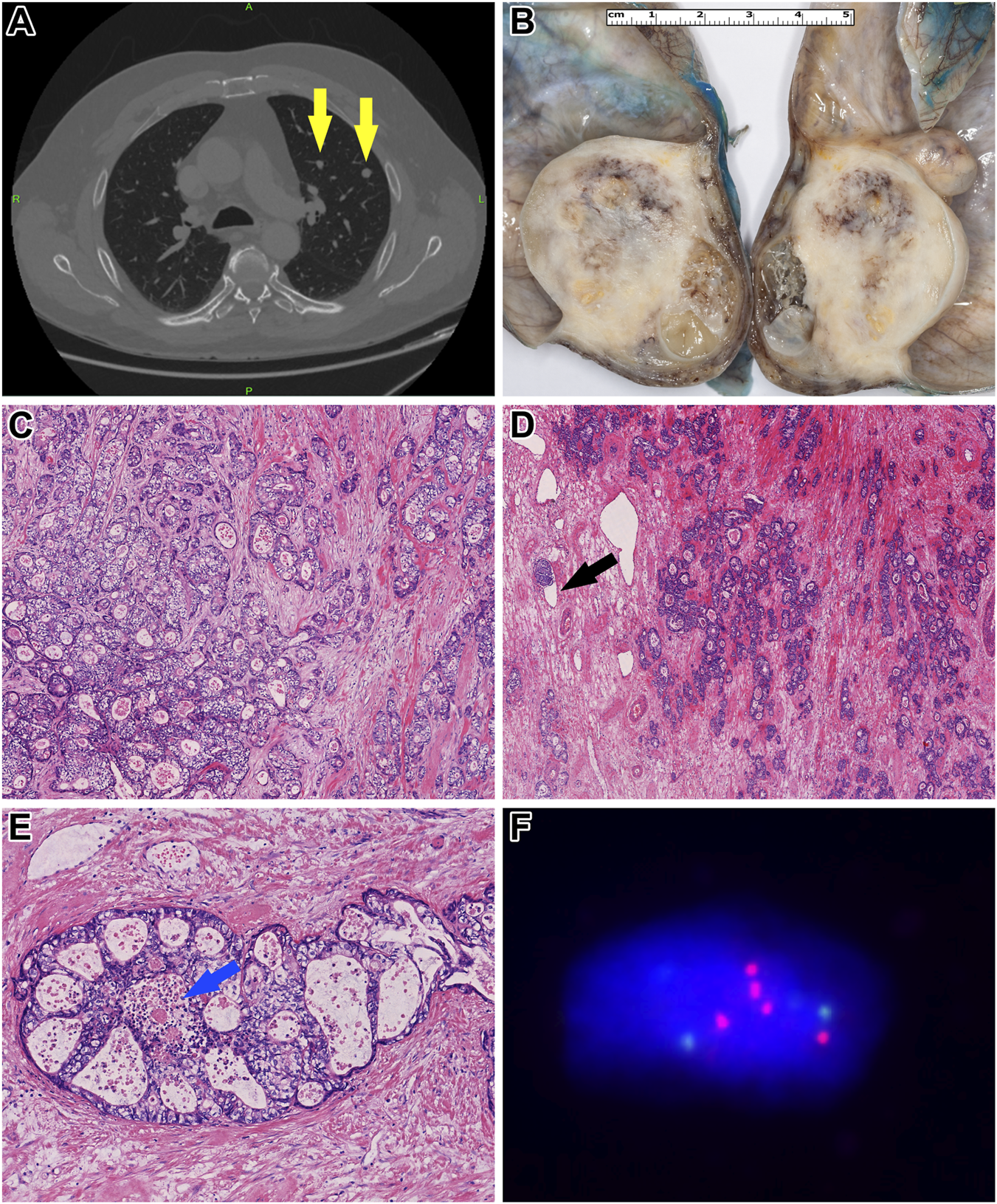 A set of six medical images. A: Chest CT scan showing two yellow arrows indicating nodules in the lung. B: Cross-section of a lung specimen with visible lesions. C: Histological section showing a dense cluster of tumor cells stained in purple and pink. D: Similar histological section with a black arrow pointing to an area of necrosis. E: Close-up of tumor cells with a blue arrow highlighting glandular formation. F: Fluorescent in situ hybridization image displaying blue, red, and green signals against a dark background, indicating genetic analysis.