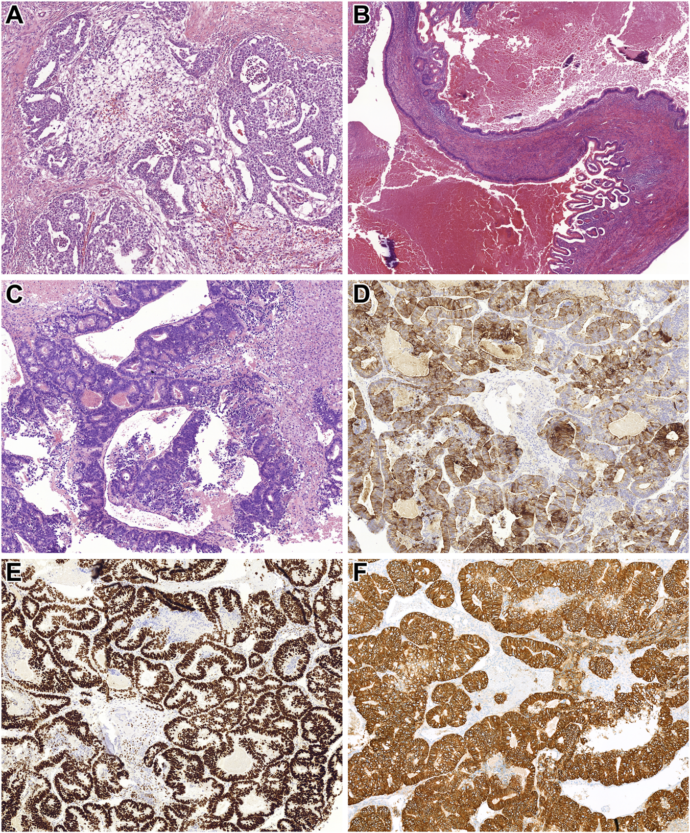 Histological image collage showing six panels (A-F). Panels A, B, and C display stained tissue sections with varying cellular and structural patterns in shades of purple and pink, indicating different tissue architectures. Panels D, E, and F exhibit immunohistochemical staining with brown and white regions, highlighting specific cellular components and arrangements. Each panel presents distinct morphological patterns and staining intensities, suggesting a comparison of tissue characteristics or diagnostic markers.