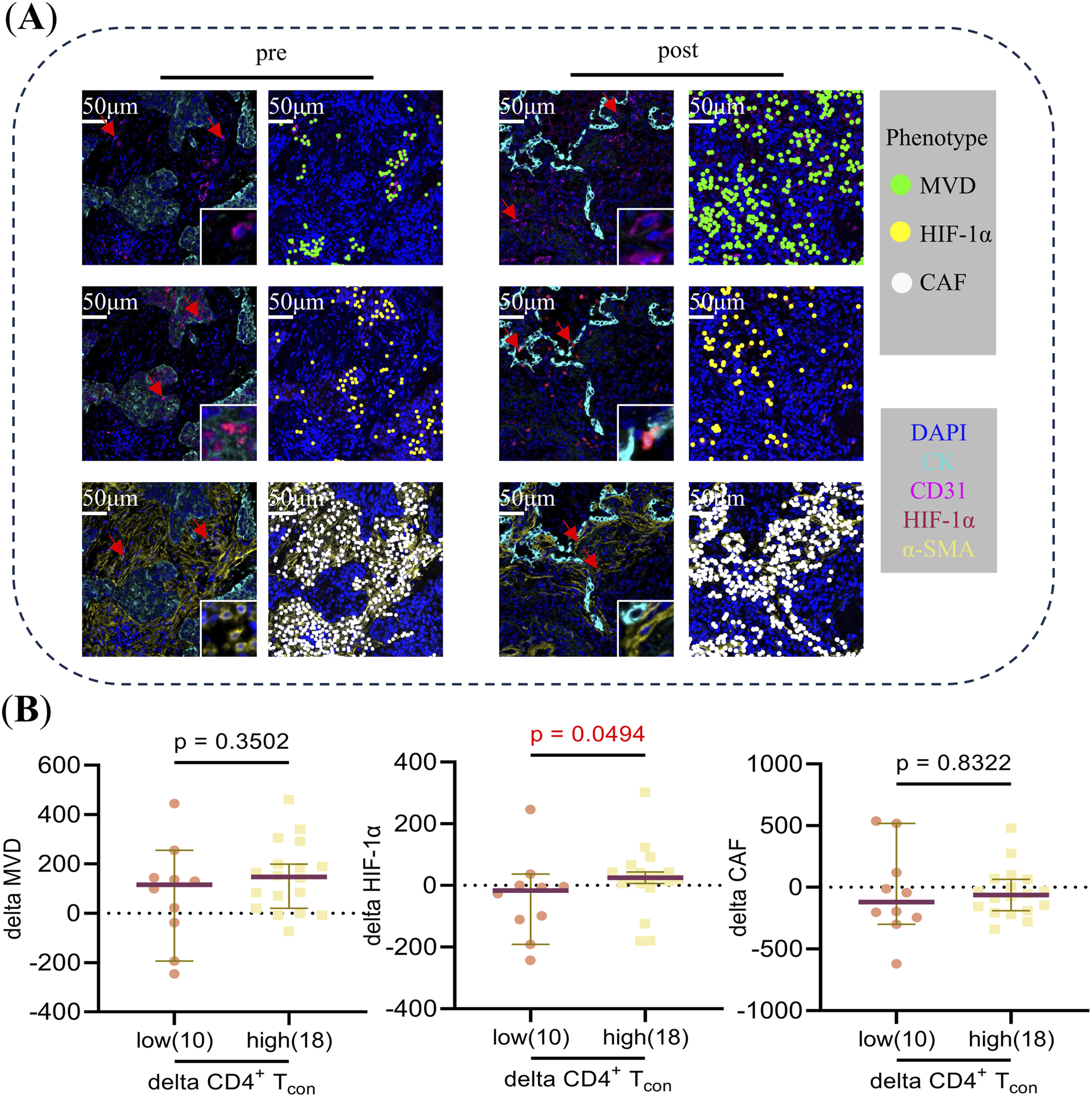 Fluorescence microscopy images and box plots. Section (A) shows pre- and post-treatment tissue samples stained for various markers, with green, yellow, and white colors representing MVD, HIF-1α, and CAF. Section (B) contains three box plots comparing low and high CD4+ T cells with changes in MVD, HIF-1α, and CAF. The plots display p-values, indicating statistical significance for HIF-1α.