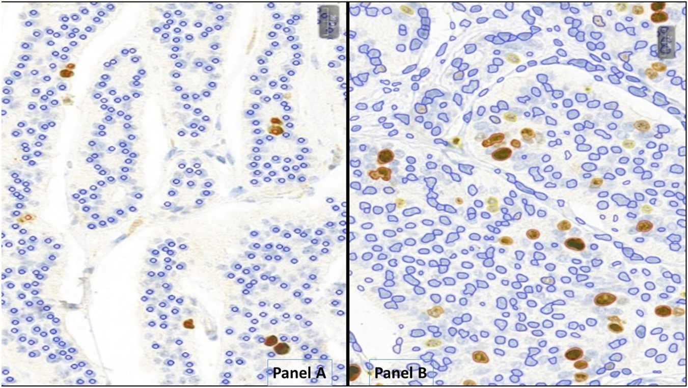 Microscopic images of tissue sections in two panels. Panel A shows tightly packed cells, outlined in blue, with sparse reddish-brown staining. Panel B displays more widely spaced cells, outlined similarly, with an increased concentration of reddish-brown staining, suggesting higher protein expression levels.