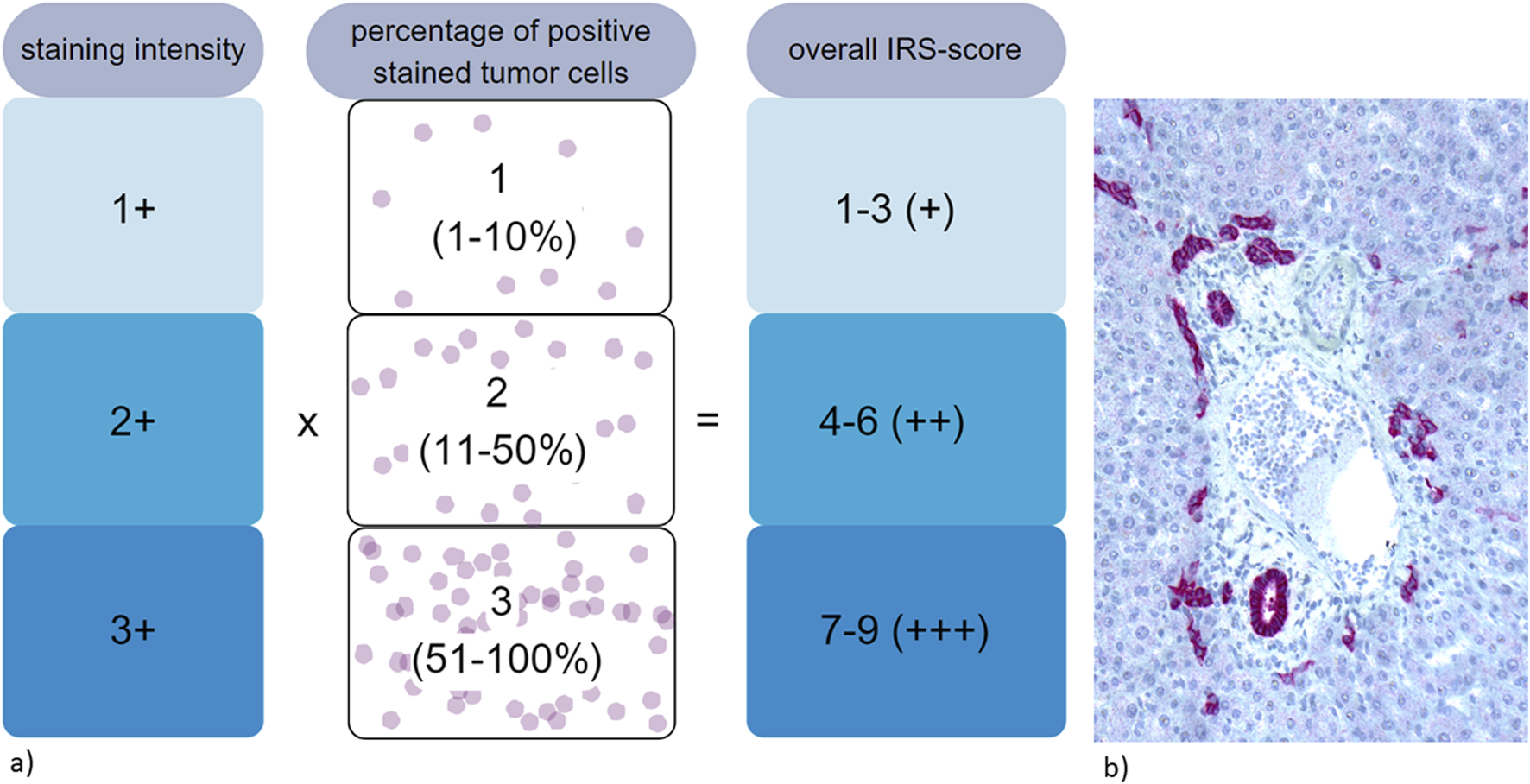 Graphic illustrating the IRS-score calculation using staining intensity and the percentage of positive stained tumor cells. Intensity ranges from 1+ to 3+, while the percentage of cells is grouped into 1 to 10%, 11 to 50%, and 51 to 100%. The overall IRS-score categories are 1-3 (+), 4-6 (++), and 7-9 (+++). Accompanying the graphic is a microscopic image showing tissue with red-stained areas.