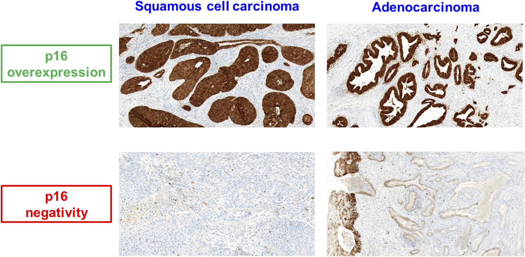 Histopathological images show squamous cell carcinoma and adenocarcinoma with p16 overexpression, indicated by brown staining, and p16 negativity, indicated by minimal staining. The top images display overexpression, while the bottom images show negativity.