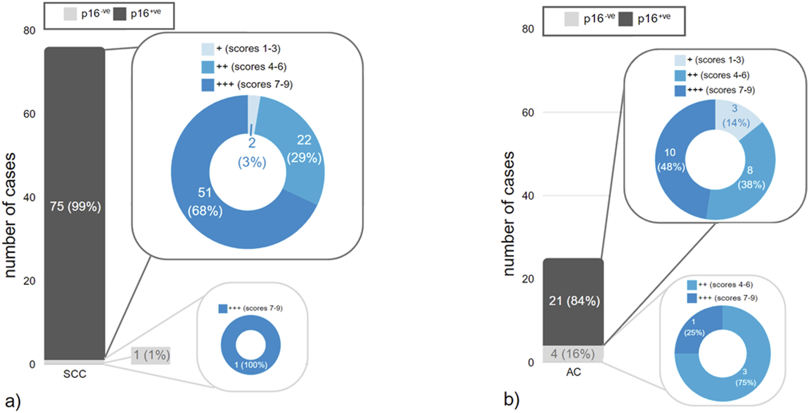 Bar and pie charts demonstrate p16 expression in SCC and AC cases. Chart (a) shows 99% p16 positive and 1% negative in SCC, with pie detail: 68% score ++, 29% score +++, 3% score +. Chart (b) shows 84% p16 positive and 16% negative in AC, with pie detail: 48% score ++, 38% score +++, 14% score +.