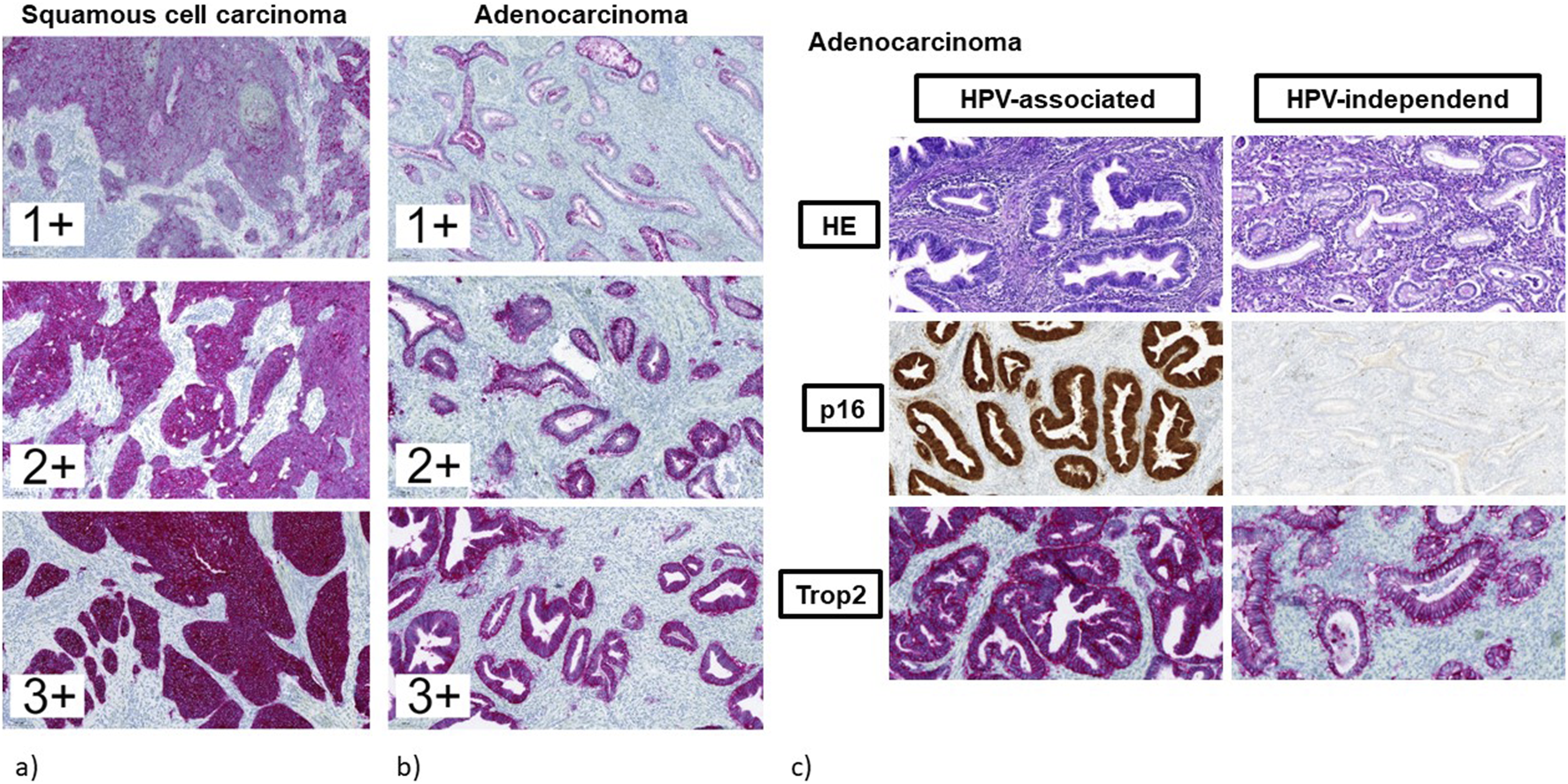 Histological comparison of squamous cell carcinoma and adenocarcinoma at different intensities marked 1+, 2+, and 3+. Additional sections display adenocarcinoma subdivided into HPV-associated and HPV-independent categories with staining for HE, p16, and Trop2, showing variations in cellular structures and staining patterns.